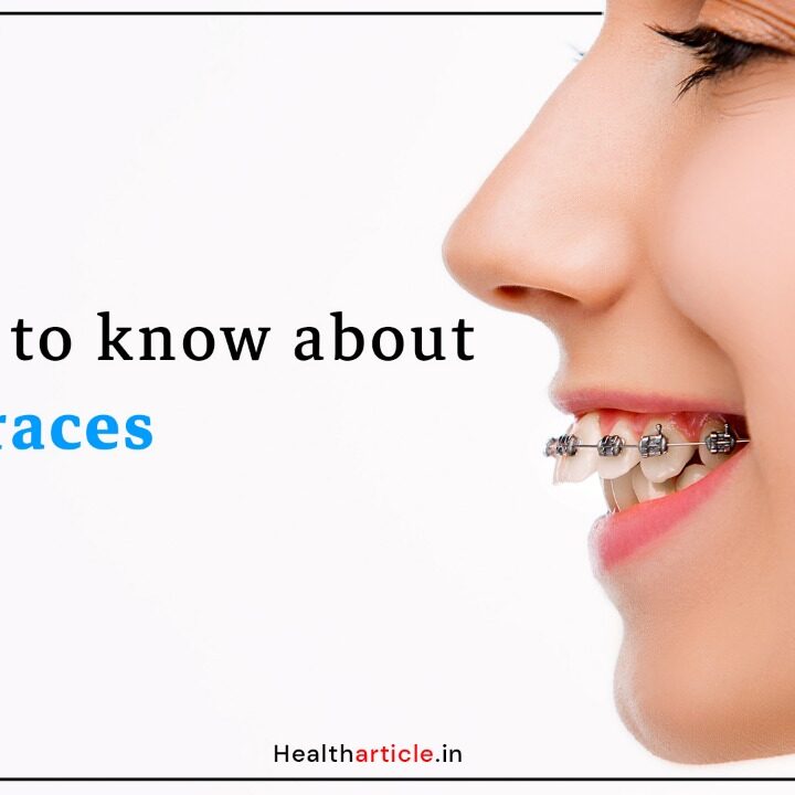 5 things to know about metal braces cost