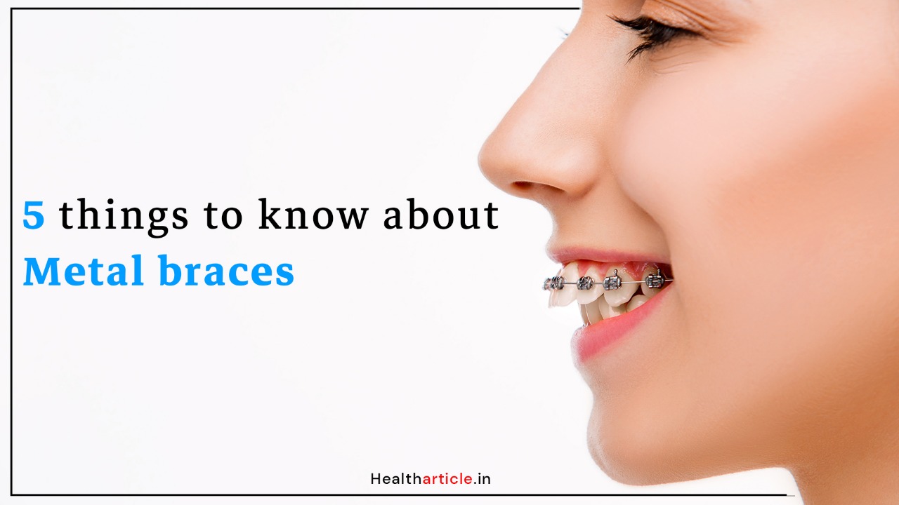 5 things to know about metal braces