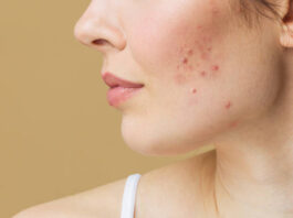 A Potential Treatment For Acne