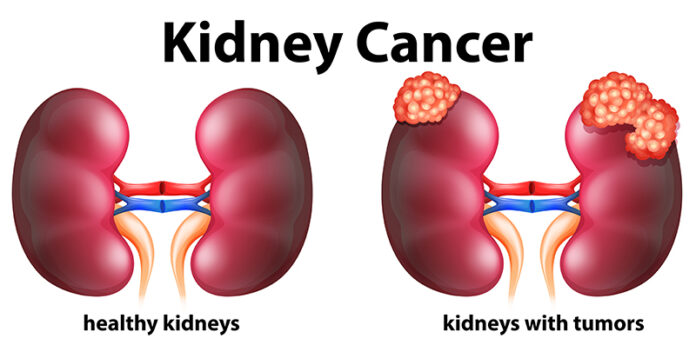 kidney cancer